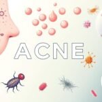 can acne go away on its own without treatment