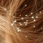 can dandruff stick to hair