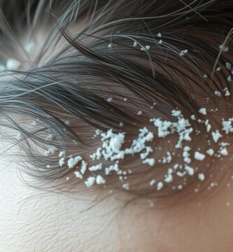 can stress cause dandruff