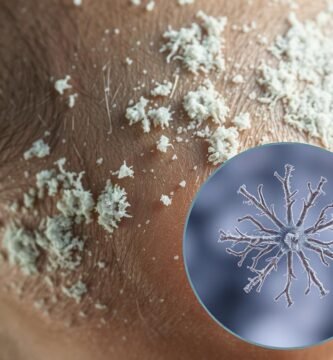 does candida cause dandruff